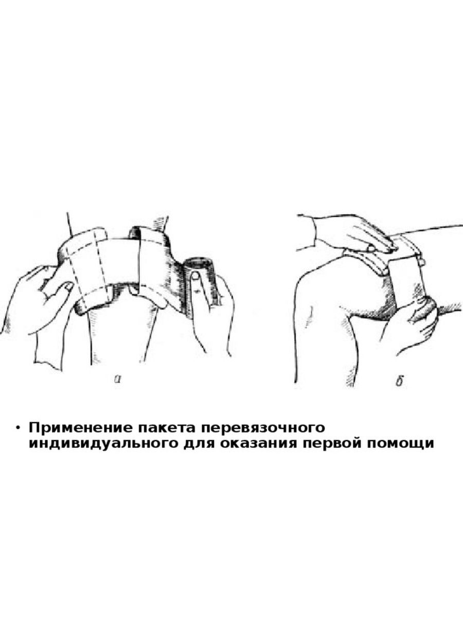 Индивидуального использования. Перевязка раны с применением пакета перевязочного индивидуального. Асептической повязки с помощью ППИ. Наложение ИПП.